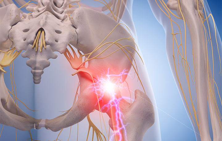 Did you know sciatic pain can be remedied naturally